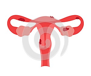 Endometriosis gynecological health disorder, overgrowth of endometrium. Risk of cancer and infertility woman. Vector