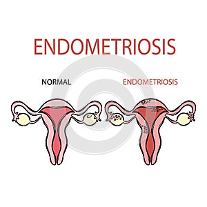 ENDOMETRIOSIS NORMAL FEMALE Reproductive System Education