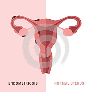 endometriosis and normal uterus womens health anatomy info graphic