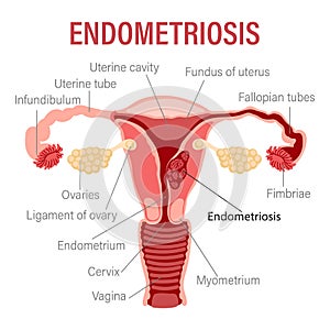 Endometriosis, schematic illustration of the uterus, diseases of the female reproductive system. Medical infographic banner.