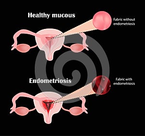 Endometriosis. The structure of the pelvic organs. Adenomyosis. The endometrium. Vector illustration photo
