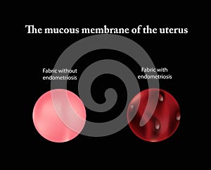 Endometriosis. The structure of the pelvic organs. Adenomyosis. The endometrium. Vector illustration