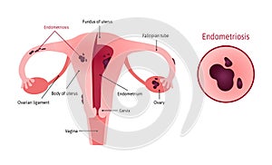 Endometriosis of uterus involves ovaries, fallopian tubes and cervix. Endometriosis close up. Womb witj vagina and ovary