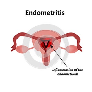 Endometritis. Inflammation of the endometrium. Inflammation of the uterus. Infographics Vector illustration on