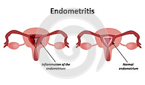 Endometritis. Inflammation of the endometrium. Inflammation of the uterus. Infographics Vector illustration on