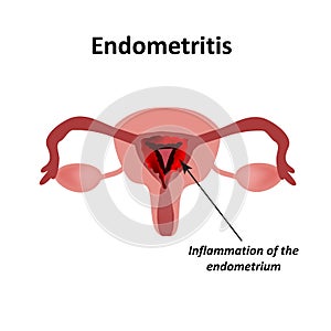 Endometritis. Inflammation of the endometrium. Inflammation of the uterus. Infographics Vector illustration on photo