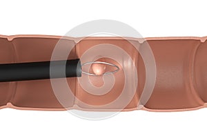 Endoscope remove colonic polyp