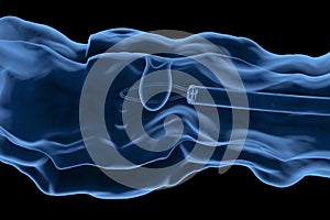 Endoscope remove colonic polyp