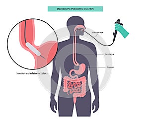 Endoscopic pneumatic dilation