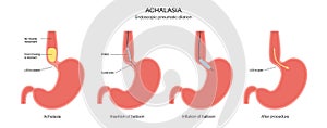 Endoscopic pneumatic dilation