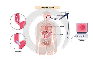 Endoscopic pneumatic dilation