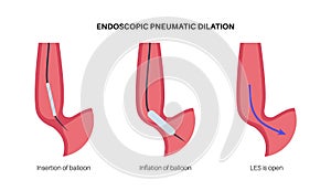 Endoscopic pneumatic dilation