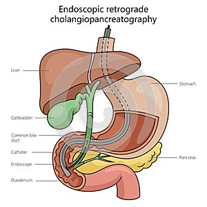 Endoscopic retrograde cholangiopancreatography