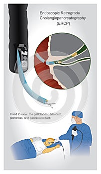 Endoscopic retrograde cholangiopancreatography ERCP