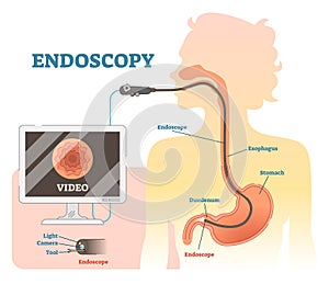 Endoscopy anatomical vector illustration diagram, medical scheme. photo
