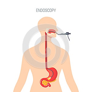 Endoscopy diagnostic,  concept in flat style photo