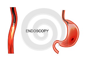 Endoscopy of the stomach. EGD. ulcer, cancer photo