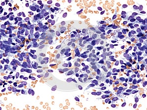 Endothelial cells in peripheral blood.