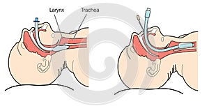 Endotracheal tube