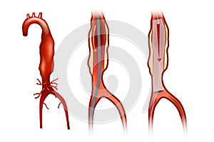 Endovascular aneurysm repair