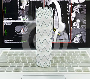 Endovascular stent graft