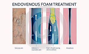 Endovenous laser treatment for varicose veins - foam sclerotherapy concept.