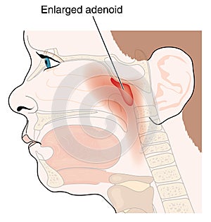 Enlarged adenoid glands