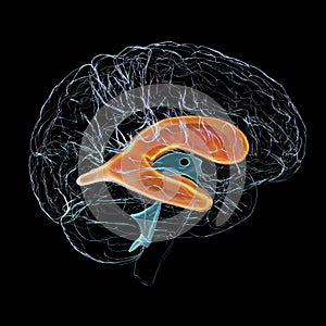 Enlarged lateral ventricles of the brain, 3D illustration