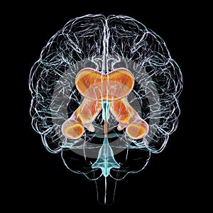 Enlarged lateral ventricles of the brain, 3D illustration