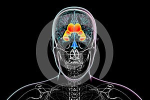 Enlarged lateral ventricles of the brain, 3D illustration