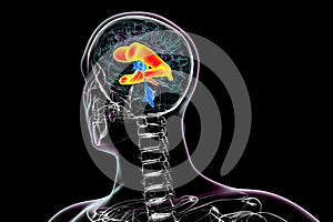 Enlarged lateral ventricles of the brain, 3D illustration