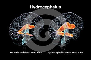 Enlarged lateral ventricles of the child brain and normal ventricular system, 3D illustration