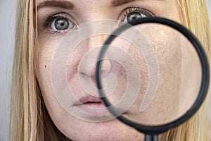 Enlarged pores, black spots, acne, rosacea close-up on the cheek. A woman is being examined by a doctor. Dermatologist examines