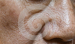 Enlarged pores in face of Asian, elder man