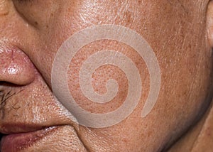 Enlarged pores in oily face of Asian, elder man with skin folds