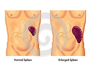 Enlarged spleen photo
