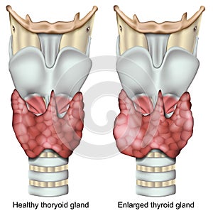 Enlarged thyroid gland 3d medical  illustration isolated on white background