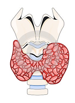 Enlarged thyroid gland affected by hyperthyroidism 2D vector illustration