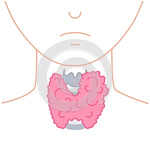 Enlarged thyroid gland on neck silhouette diagram