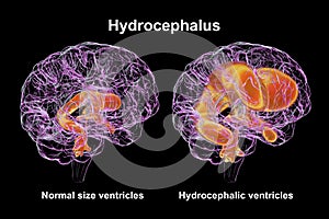 Enlarged ventricles of the child brain and normal ventricular system, 3D illustration