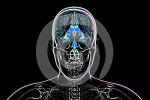 Enlargement of the third brain ventricle, 3D illustration