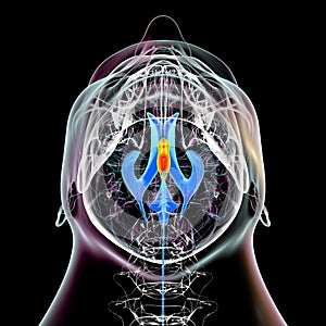 Enlargement of the third brain ventricle, 3D illustration