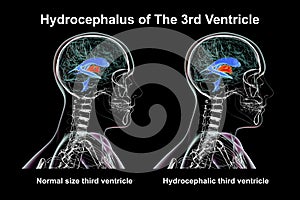 Enlargement of the third brain ventricle, 3D illustration