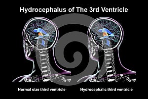 Enlargement of the third brain ventricle, 3D illustration