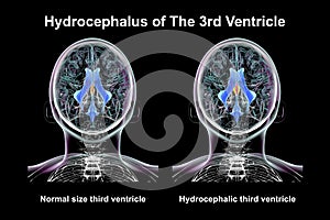 Enlargement of the third brain ventricle, 3D illustration