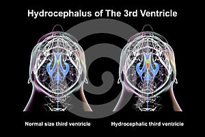 Enlargement of the third brain ventricle, 3D illustration
