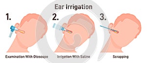 ENT doctor irrigate ears. Doctor checking ear canals, removing