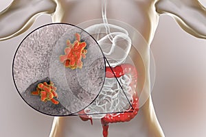 Entamoeba histolytica protozoan infection of large intestine