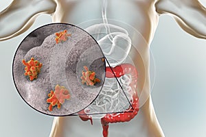 Entamoeba histolytica protozoan infection of large intestine