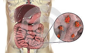 Entamoeba histolytica protozoan infection of large intestine